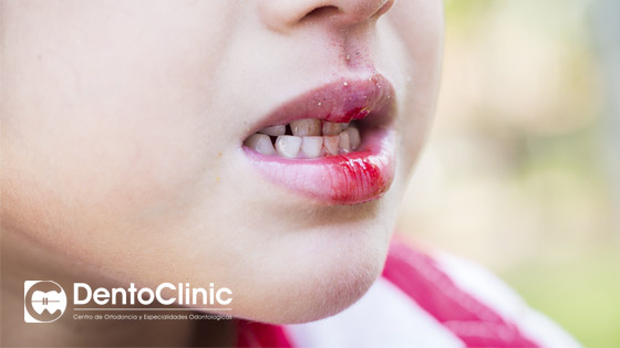 ¿Qué hacer ante un traumatismo dental en niños?