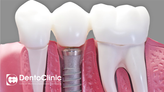 Diferencias entre un implante dental unitario y puentes dentales