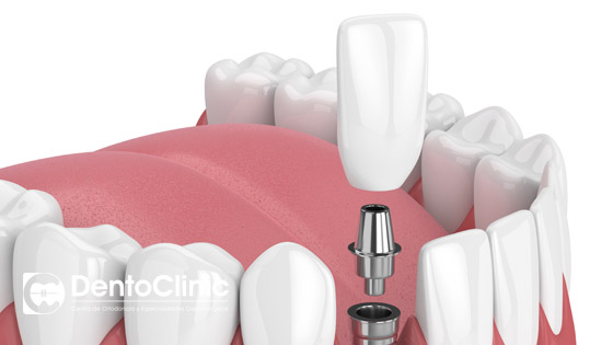 ¿Qué son los implantes cortos?