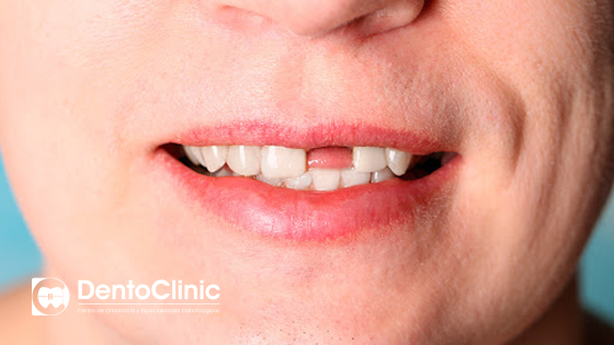 ¿Cuándo estará indicada una extracción dental?